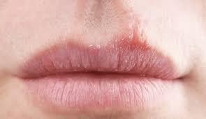 입술 물집 입술 포진 입술 헤르페스