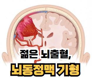젊은 뇌출혈, 뇌동정맥 기형